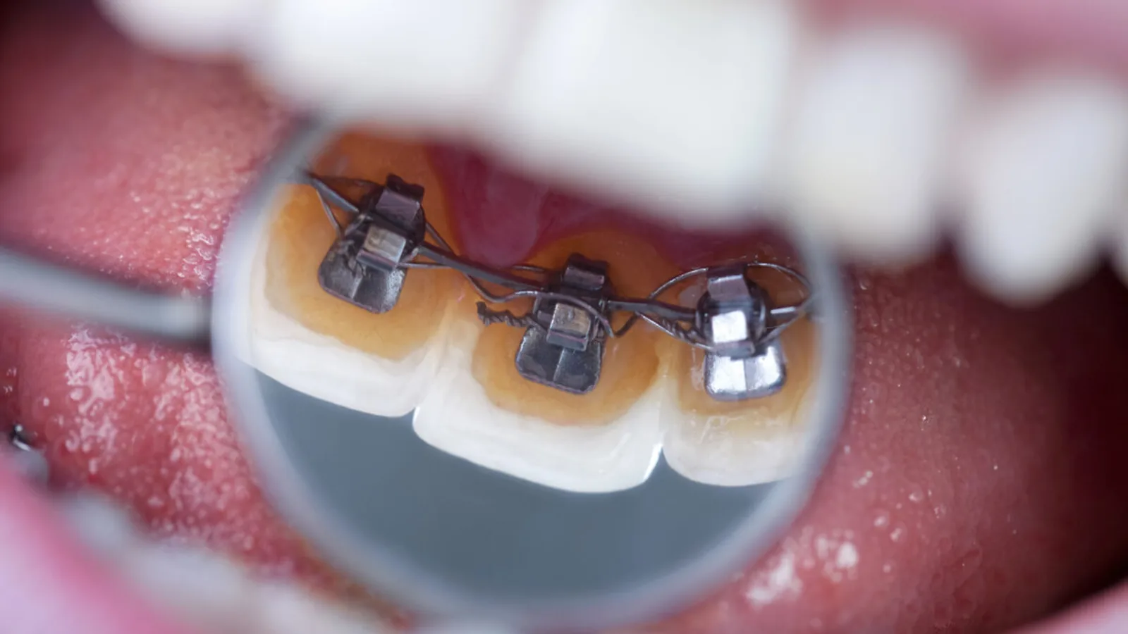 Miroir dentaire reflétant un appareil orthodontique collé sur la face interne des dents